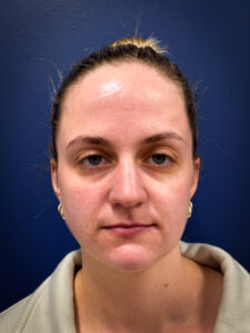 Liposuction-Case--4705 | After Submental Liposuction 1