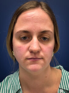 Liposuction-Case--4705 | Before Submental Liposuction 1