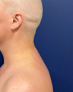 Case--9534 | After Dr. Frank Albino 1