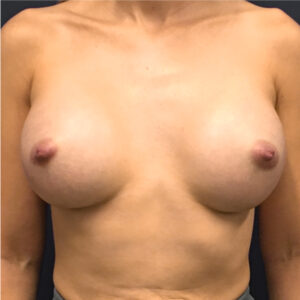 Breast-Augmentation-Case--8208 | After Breast Augmentation 1