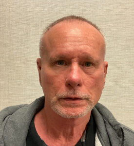 Facelift-Case--7592 | After Facelift for Men 1