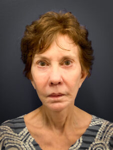 Facelift-Case--8727 | After Facelift 1