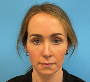 Rhinoplasty-Case--1281 | After Rhinoplasty 1