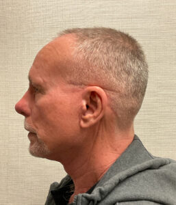 Facelift-Case--7592 | After Facelift for Men 2