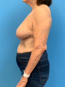 Augmentation-Mastopexy-Case--4504 | After Breast Augmentation With Lift 2