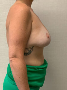 Augmentation-Mastopexy-Case--6355 | After Breast Lift 2