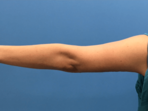 Case--276 | After Arm Lift 1