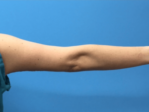 Case--276 | After Arm Lift 2