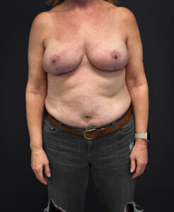 After Mastopexy and Galaflex (front profile)