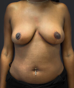 Front profile of patient after undergoing breast reduction surgery