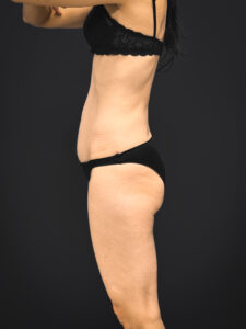 Tummy-Tuck-Case--2729 | After Tummy Tuck 2