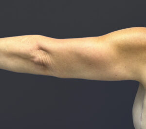 Brachioplasty-Case--6382 | After Arm Lift 2