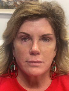 Case--15055 | After Face360 1