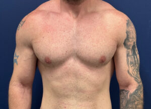 Case--28230 | After Gynecomastia / Male Breast Reduction 1