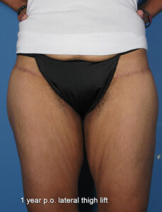 Case--75 | After Thigh Lift 1