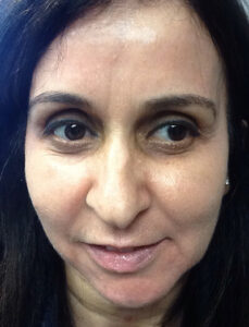 Case--36 | After CPS Plastic Surgeons 1