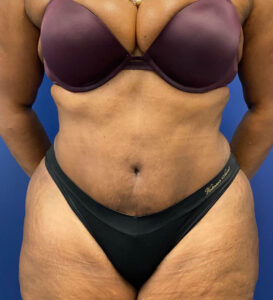 Case--24124 | After Tummy Tuck 1