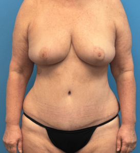 Case--27387 | After Mommy Makeover 1