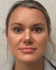 Case--23703 | After Rhinoplasty 1