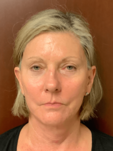 Case--22069 | After Face360 1