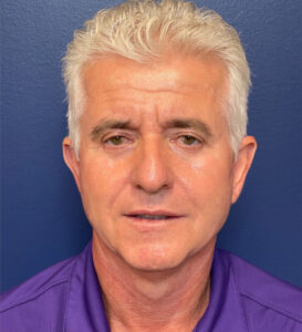 Case--291 | After Facelift for Men 1