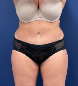 Case--24903 | After Tummy Tuck 1