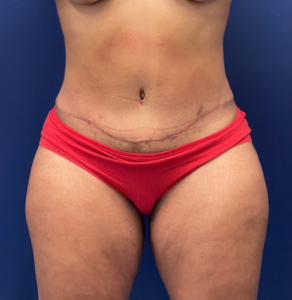 Liposuction-Case--254 | After Liposuction 1