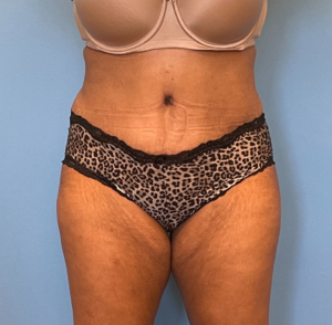 Lipoabdominoplasty-Case--255 | After Liposuction 1