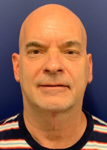 Case--22080 | After Neck Lift 1