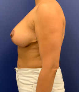 Breast-Reduction-Case--25560 | After Dr. Wesley Price 2