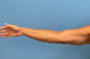 Right arm profile of patient after undergoing brachioplasty procedure