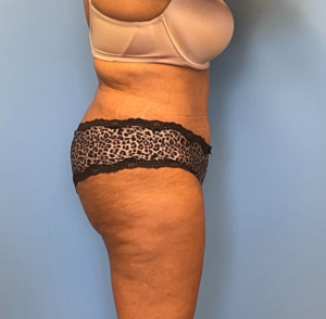 Lipoabdominoplasty-Case--255 | After Liposuction 2