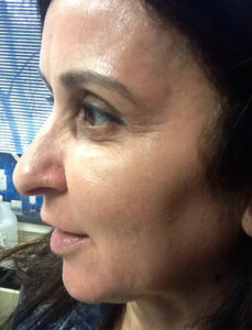 Case--36 | After CPS Plastic Surgeons 2