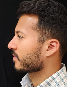 Rhinoplasty-Case--379 | After Rhinoplasty for Men 2