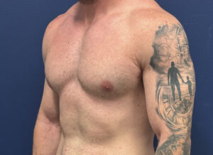 Case--28230 | After Gynecomastia / Male Breast Reduction 2