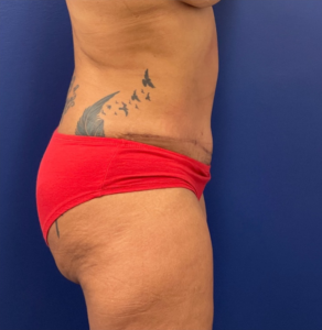 Liposuction-Case--254 | After Liposuction 2