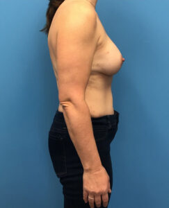 Case--139 | After DIEP Flap 2