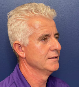 Case--291 | After Facelift for Men 2