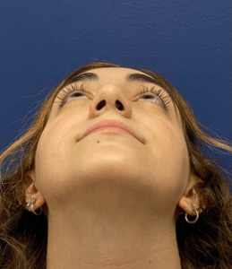 Rhinoplasty-Case--2537 | After Rhinoplasty 2