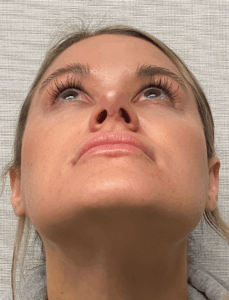 Rhinoplasty-Case--4972 | After Rhinoplasty 2