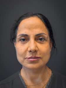 Facelift-Case--7062 | After Facelift 1