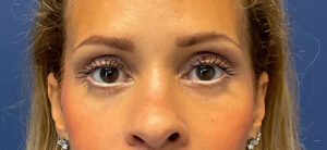 Quad-Blepharoplasty-Case--1261 | After Eyelid Surgery 1