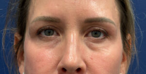 Blepharoplasty-Case--8003 | After Eyelid Surgery 1