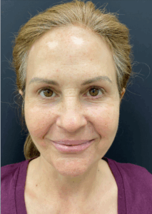 Facelift-Case--4160 | After Facelift 1