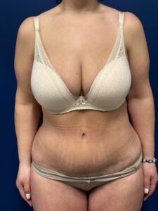 Abdominoplasty-Case--3602 | After Tummy Tuck 1