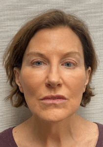 Case--6591 | After Facelift 1