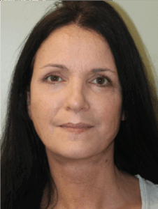 Face-and-Neck-Lift-Case--9403 | After Neck Lift 1