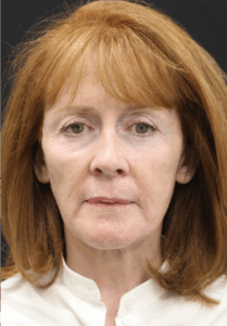 Face-and-Neck-Lift-Case--9302 | After Neck Lift 1