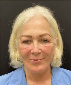 Facelift-Case--8874 | After Facelift 1