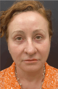 Face-and-Neck-Lift-Case--8423 | After Neck Lift 1